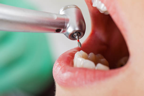 Best Emergency Dental Care for Broken or Chipped Teeth in Fort Irwin, CA